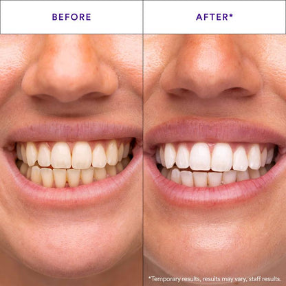 Hismile V34 Whitening Strips, Purple Tooth Whitening, Combining Whitening and Colour Correction